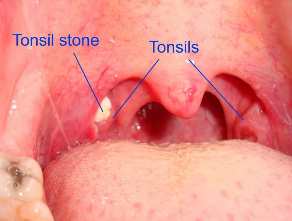 Tonsils with a tonsil stone