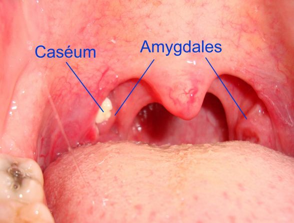 Des amygdales avec du caséum